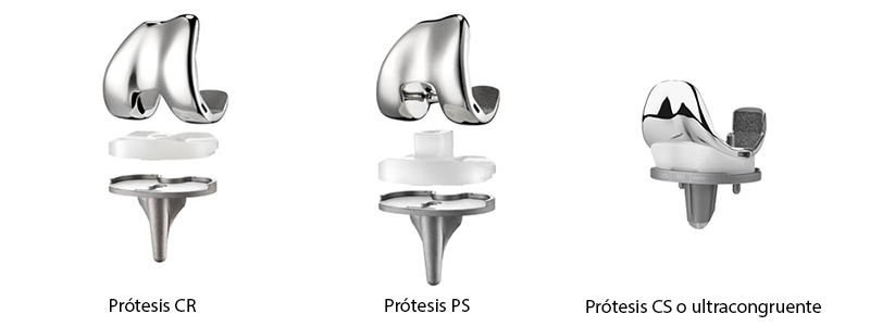 prótesis totales de rodilla: tipos