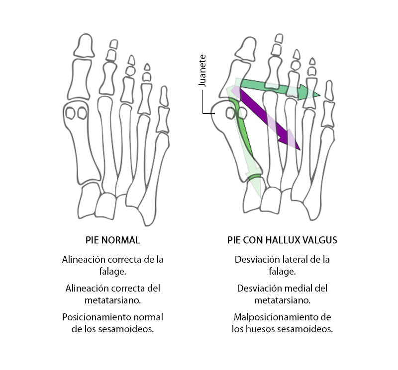 hallux valgus