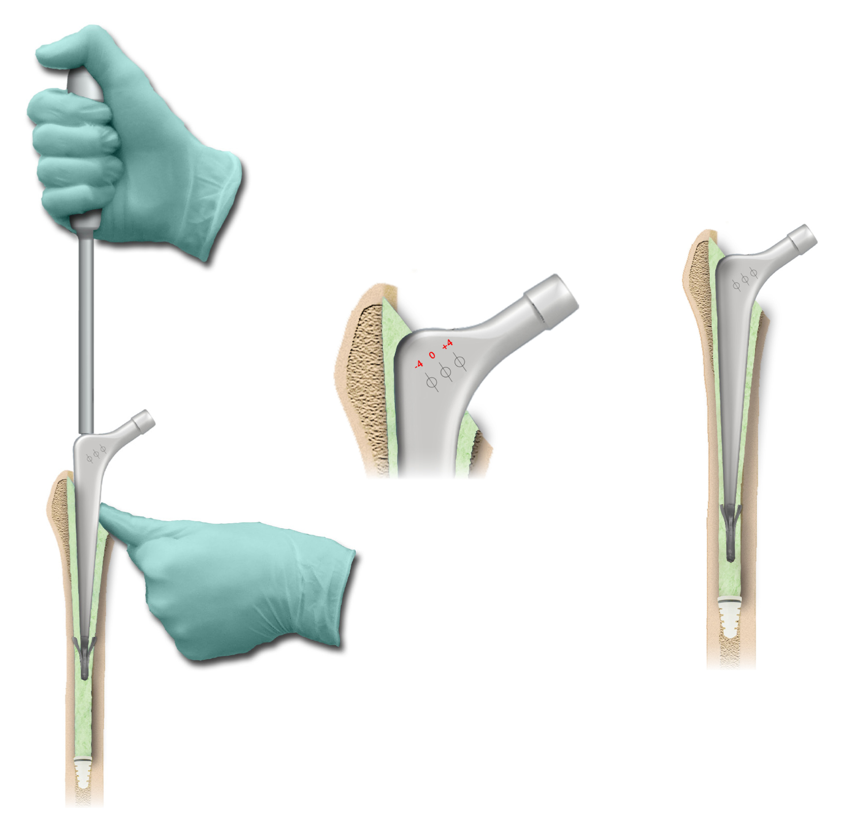 características de las prótesis para fracturas