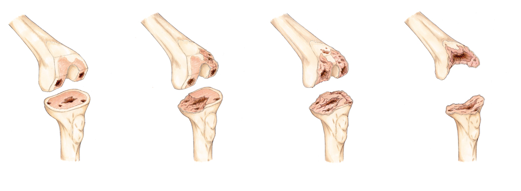¿Cuál es la mejor prótesis de rodilla para cada tipo de paciente?