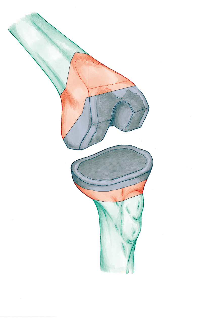 ¿Qué protesis de rodilla usar?
