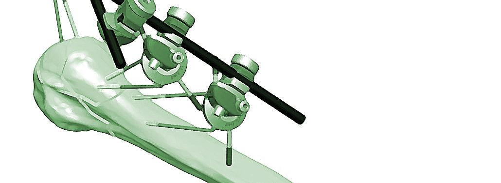Fracturas De Hombro. Opciones De Tratamiento