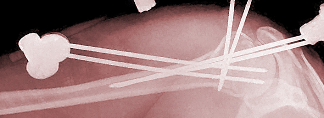 Fracturas De Hombro: Todo Lo Que Necesita Saber
