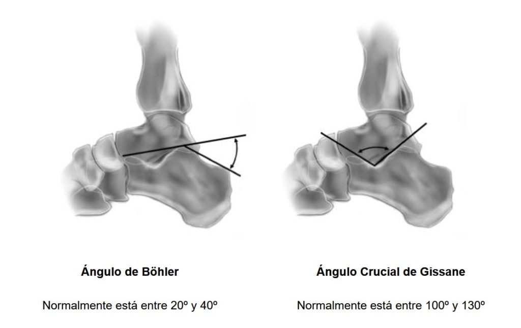 ángulos de Böhler y de Gissane del hueso calcáneo